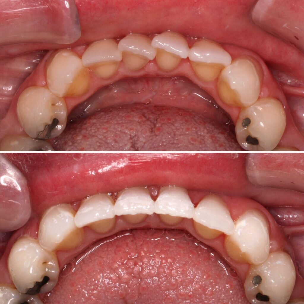 Moderate crowding bottom teeth
