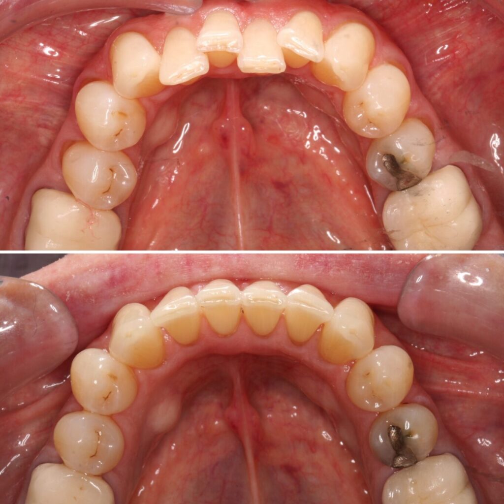 Moderate crowding lower teeth