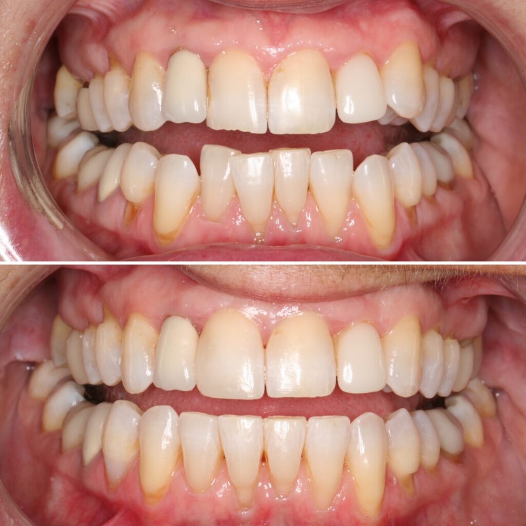 Crooked upper and lower teeth | Teeth before after | Invisalign Services | Schaumburg IL