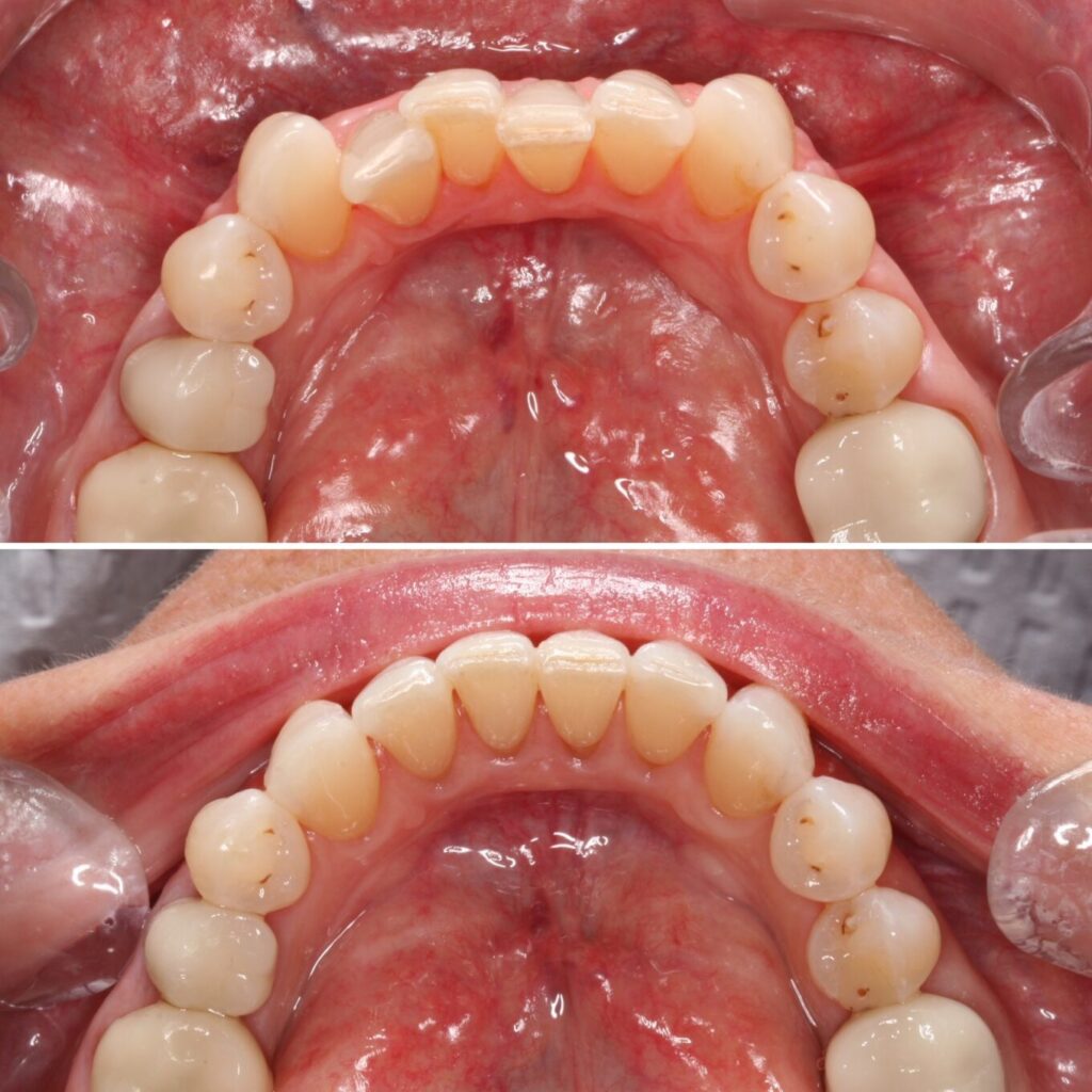 Lower crowding | Teeth before after | Invisalign Services | Schaumburg IL