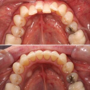 Moderate crowding lower teeth | Teeth before after | Invisalign Services | Schaumburg IL