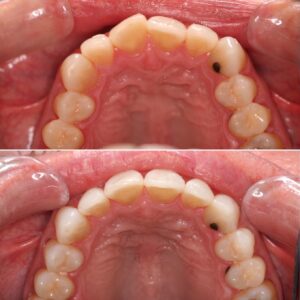 Moderate crowding upper teeth | Teeth before after | Invisalign Services | Schaumburg IL