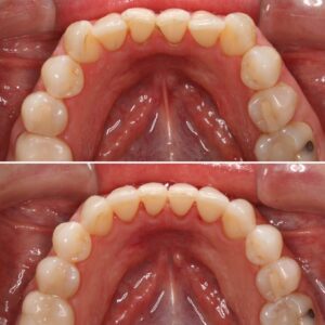 Moderate lower crowding | Teeth before after | Invisalign Services | Schaumburg IL