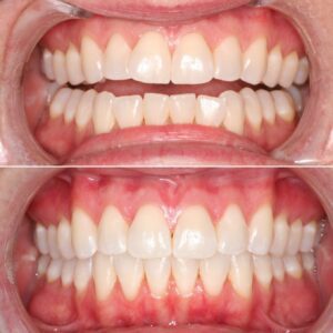 Perfect results with Invisalign | Teeth before after | Invisalign Services | Schaumburg IL