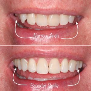 Narrow to broader smile | Teeth before after | Invisalign Services | Schaumburg IL