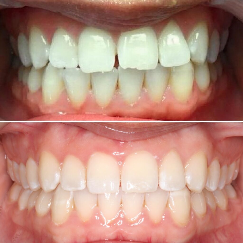 Space between front teeth | Teeth before after | Invisalign Services | Schaumburg IL
