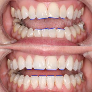 Teeth Alignment | Teeth before after | Invisalign Services | Schaumburg IL