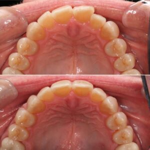 Uneven upper teeth | Teeth before after | Invisalign Services | Schaumburg IL