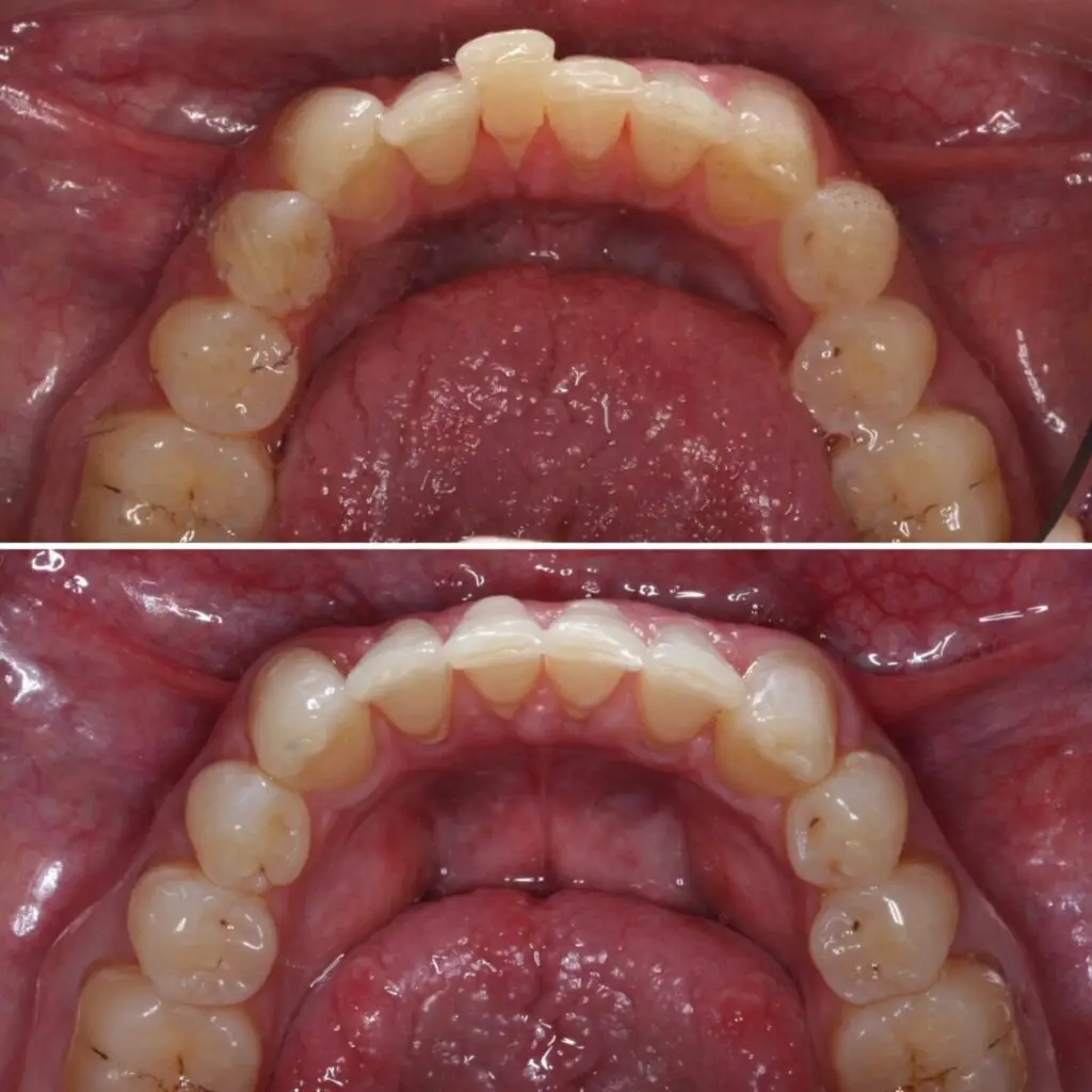 invisalign-dentist-near-me-schaumburg-il-before-after-photos-1