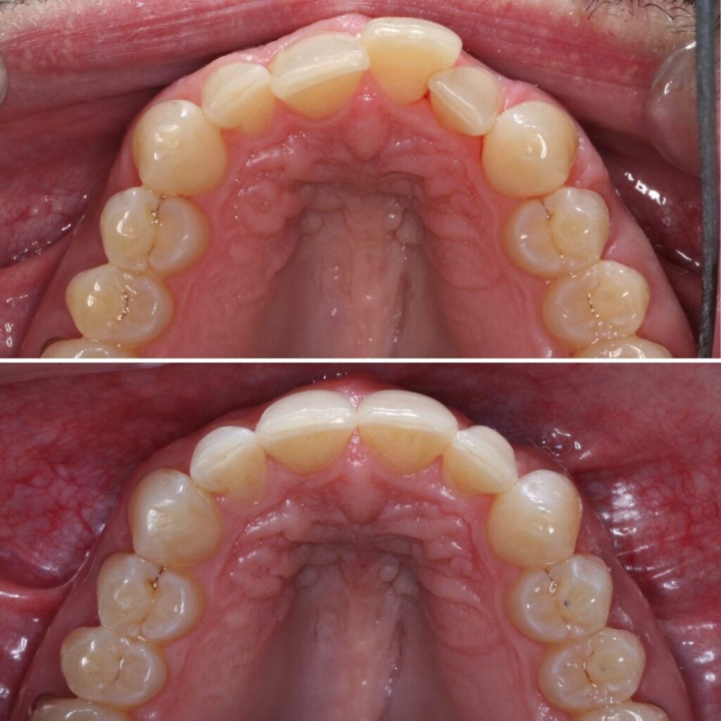 invisalign-dentist-near-me-schaumburg-il-before-after-photos-2