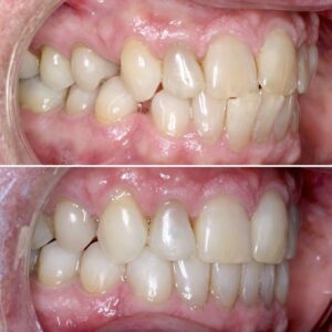 Teeth before after | Invisalign Services | Schaumburg IL