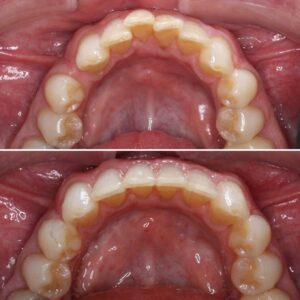 Teeth before | Invisalign Services | Schaumburg IL