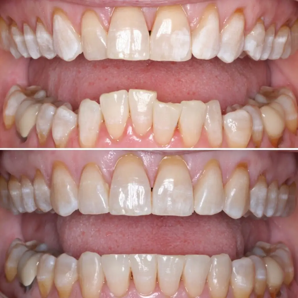 A person's teeth before and after Invisalign treatment.