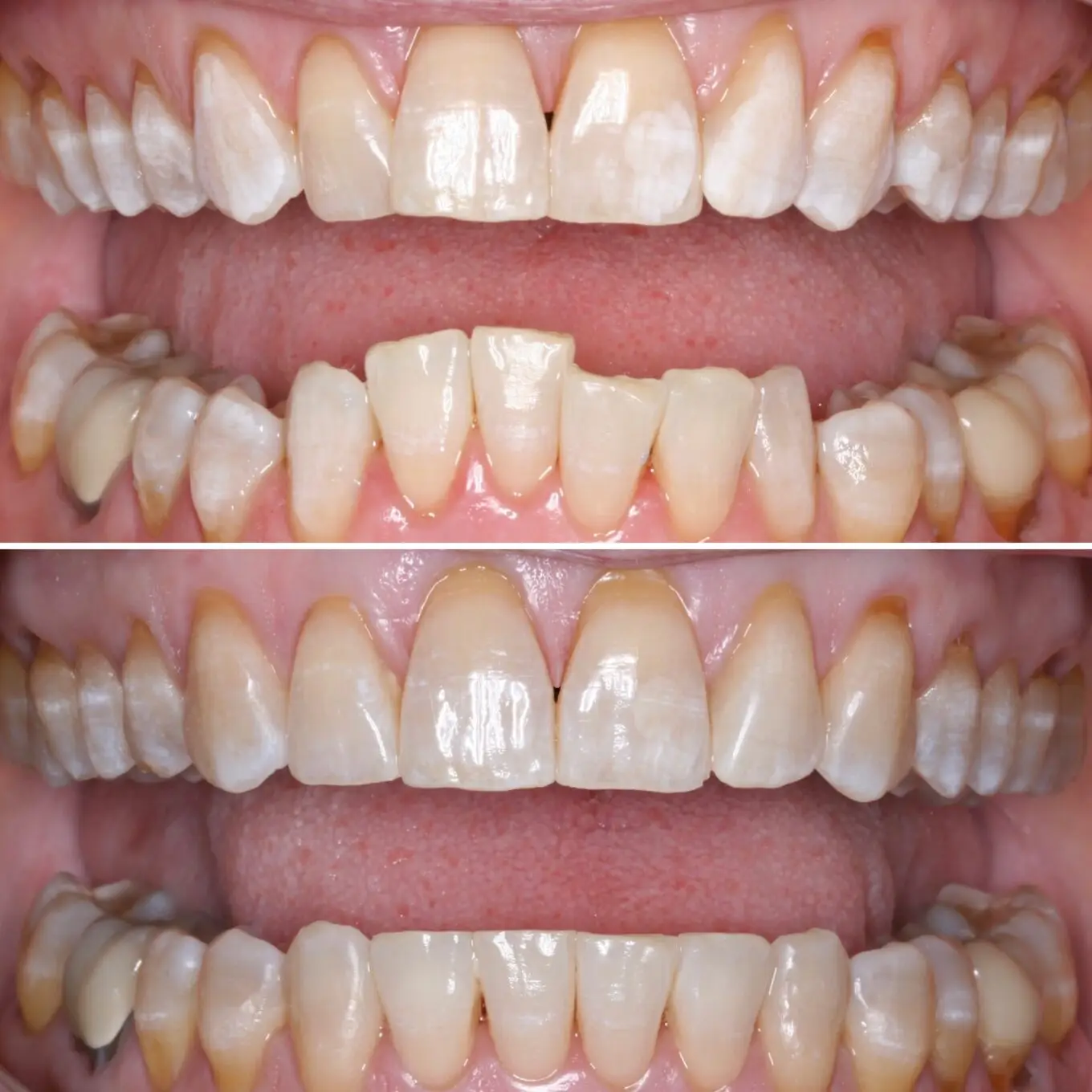 A person's teeth before and after Invisalign treatment.
