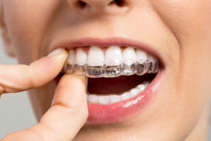 An Overview of Invisalign, “Clear Aligners”