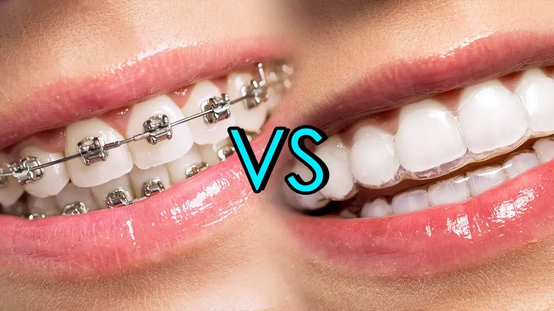 Invisalign Before and After (Amazing Results)