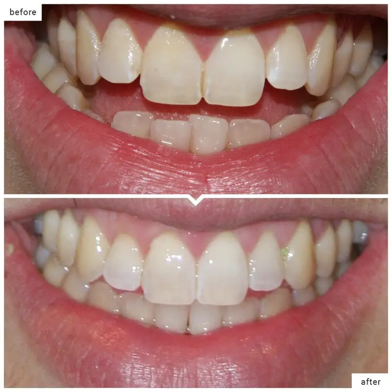 Cosmetic Dentistry​: Before and After | Schaumburg Dentistry