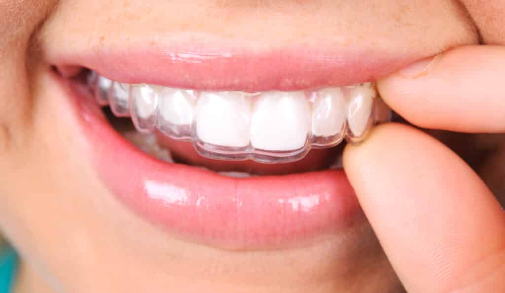How Does Invisalign Work At Schaumburg Dentistry?