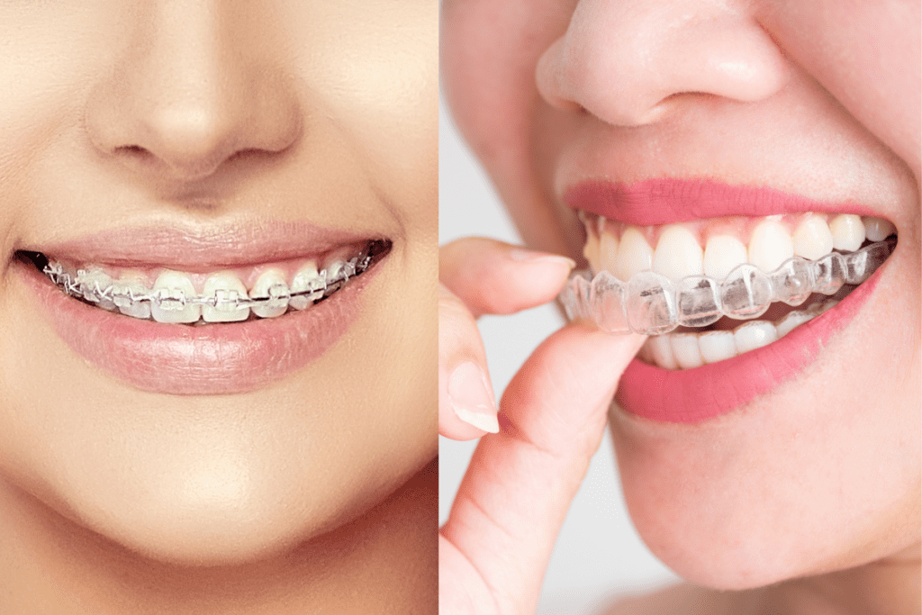 Invisalign Tooth Straightening System: The Difference Between Invisalign And Metal Braces