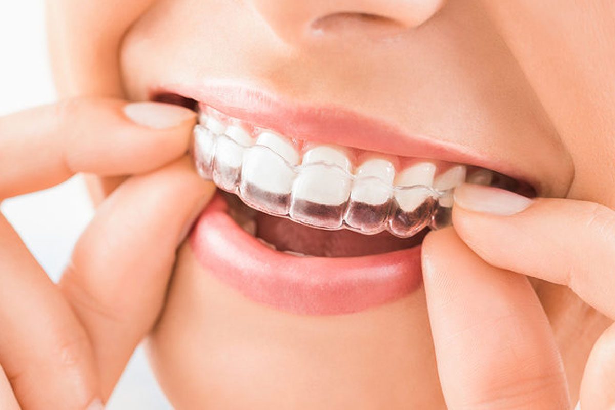 11 Hacks For Using Invisalign In 2022 (Tips From An Invisalign Doctor)