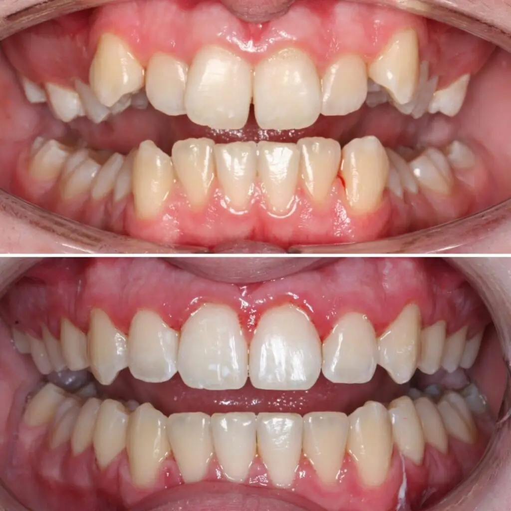 invisalign-before-after-photos-schaumburg-dentistry-1