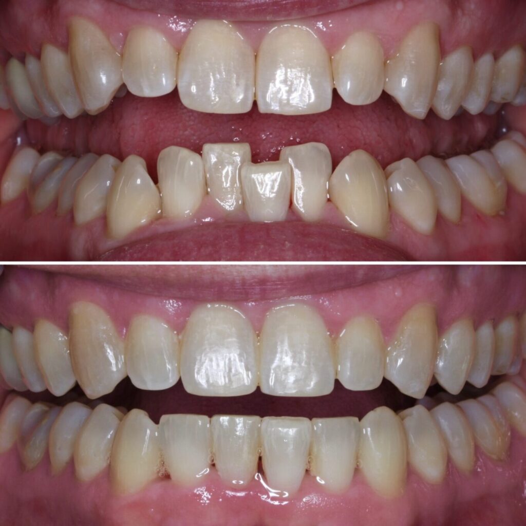 invisalign-before-after-photos-schaumburg-dentistry-2
