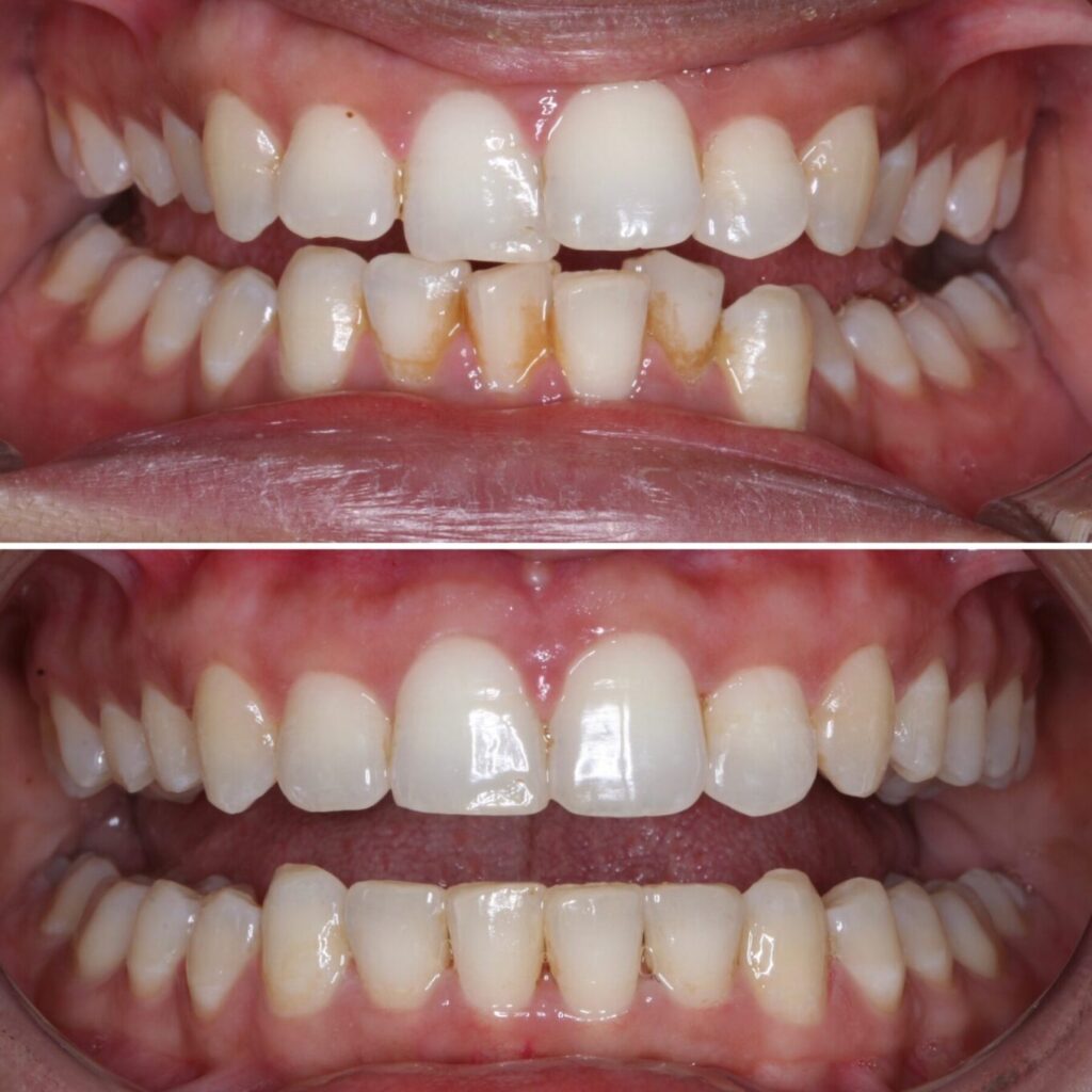 invisalign-before-after-photos-schaumburg-dentistry-3