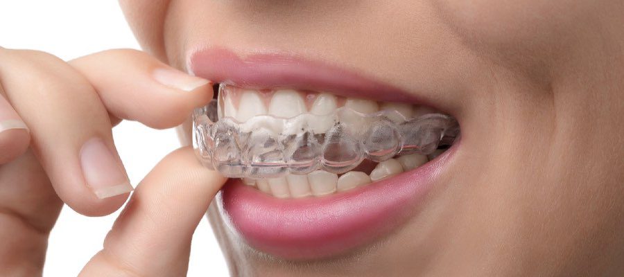 Rules for Invisalign Users