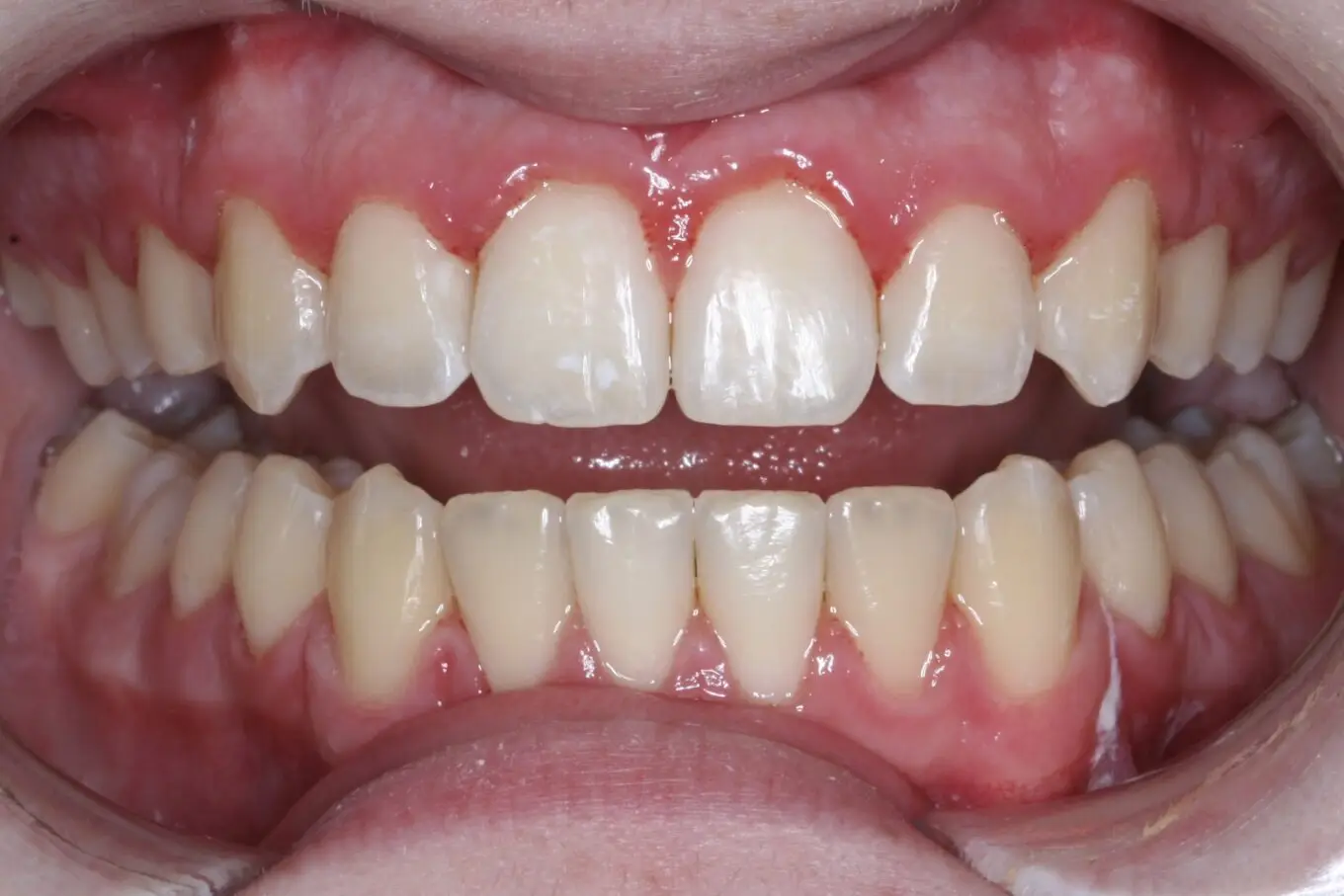 Teeth after | Invisalign Services | Schaumburg IL