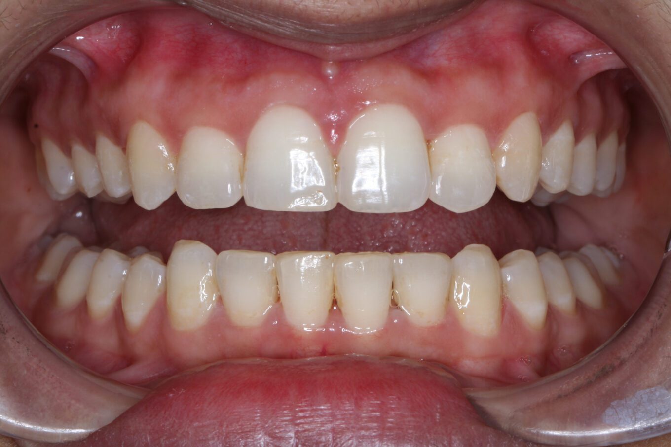 Teeth after | Invisalign Services | Schaumburg IL