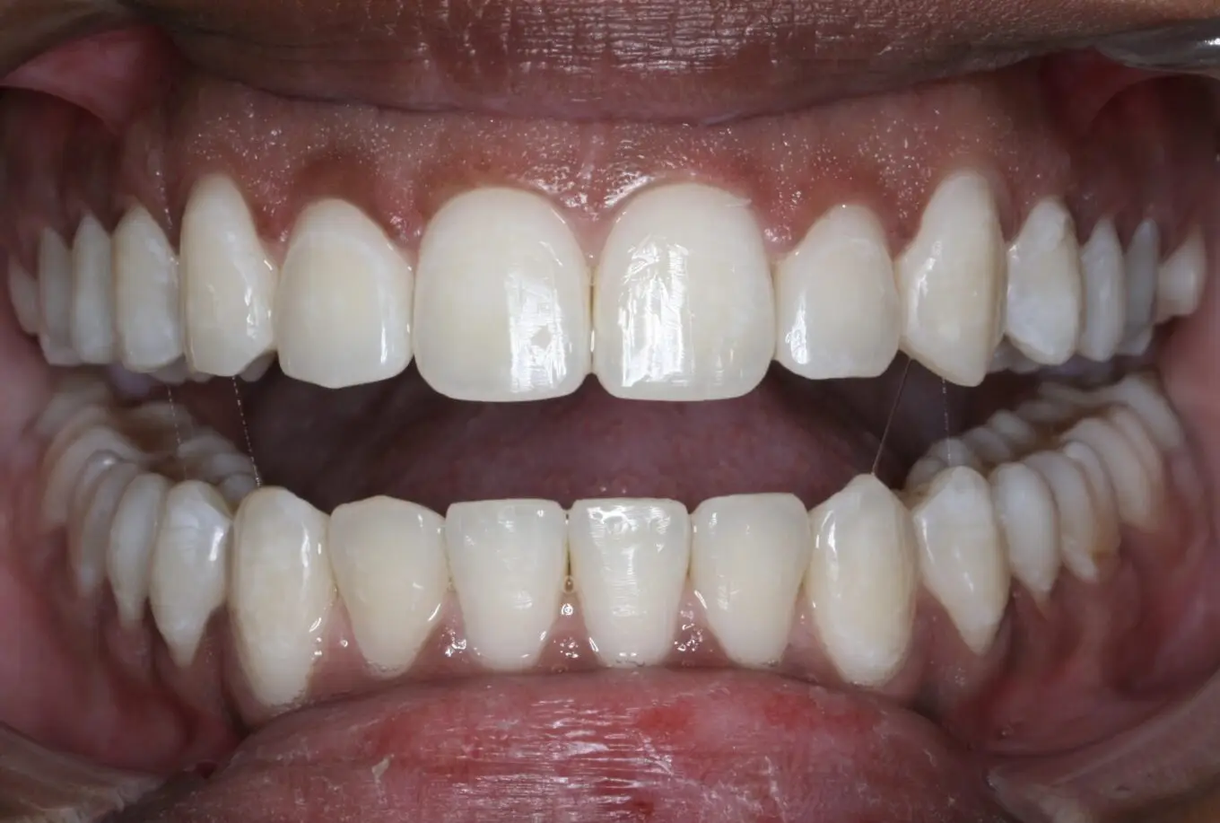 Teeth after | Invisalign Services | Schaumburg IL