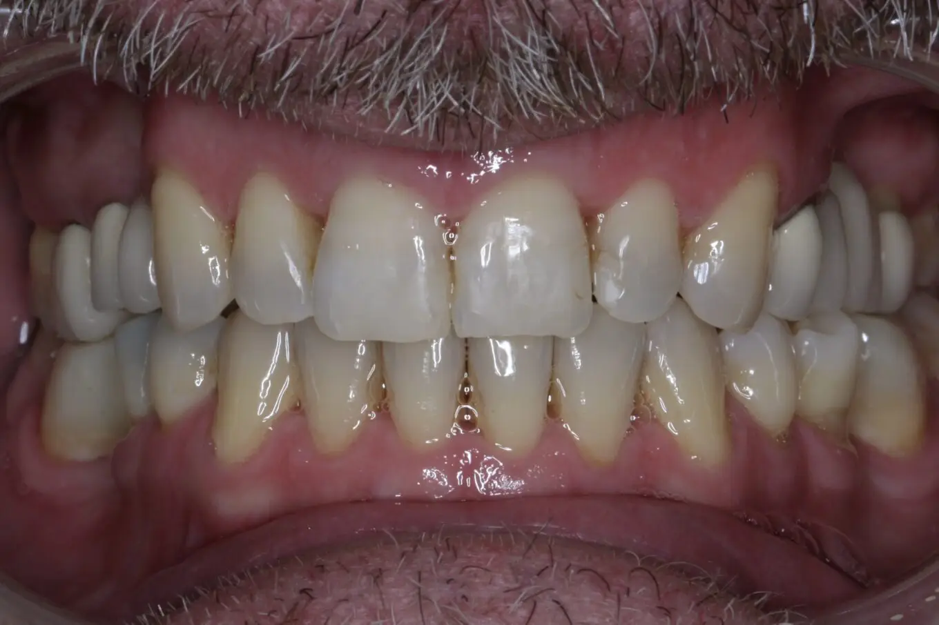 Teeth after | Invisalign Services | Schaumburg IL
