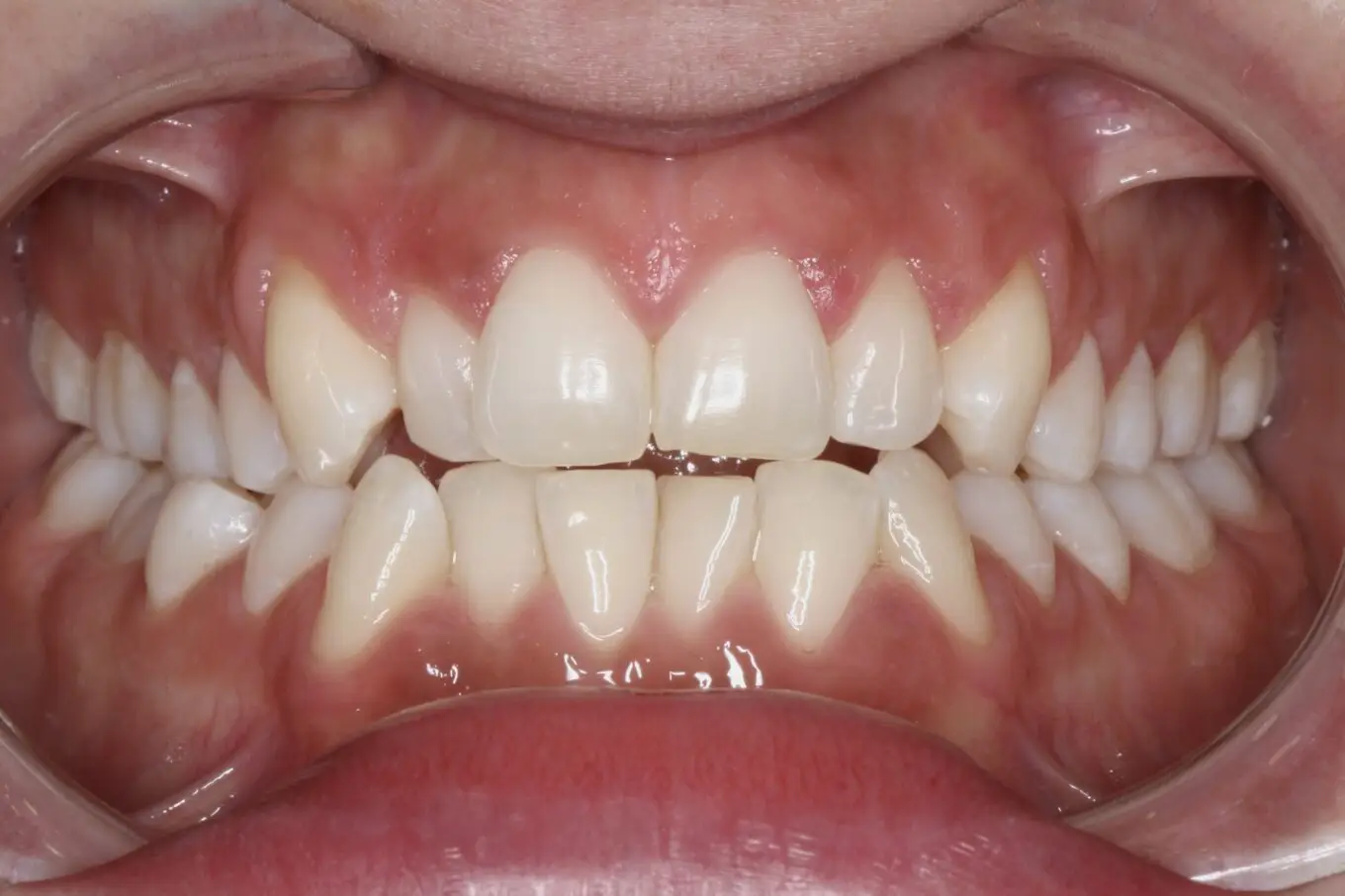 Teeth after | Invisalign Services | Schaumburg IL