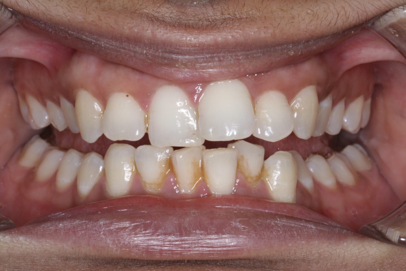 Teeth before | Invisalign Services | Schaumburg IL