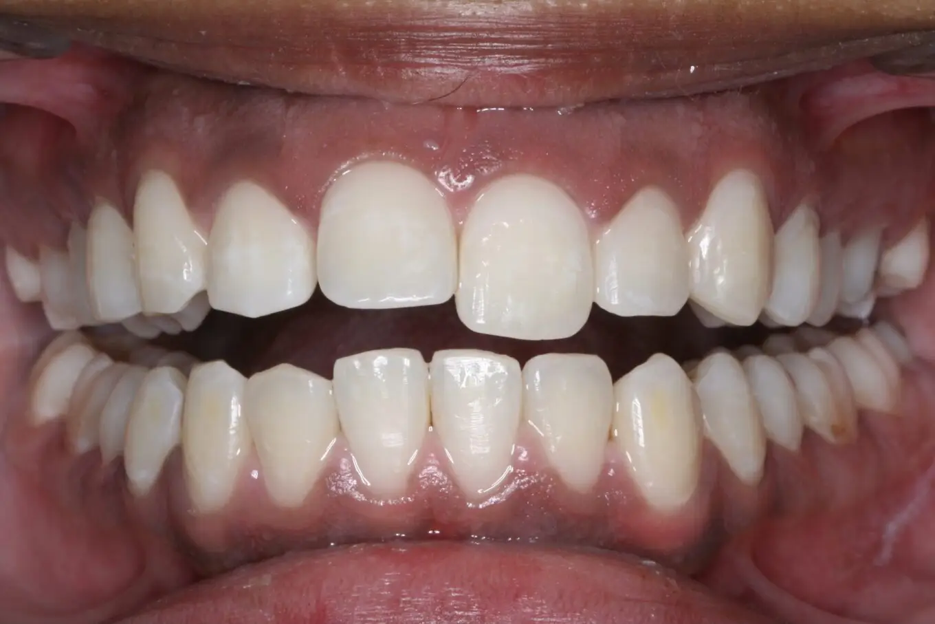 Teeth after | Invisalign Services | Schaumburg IL
