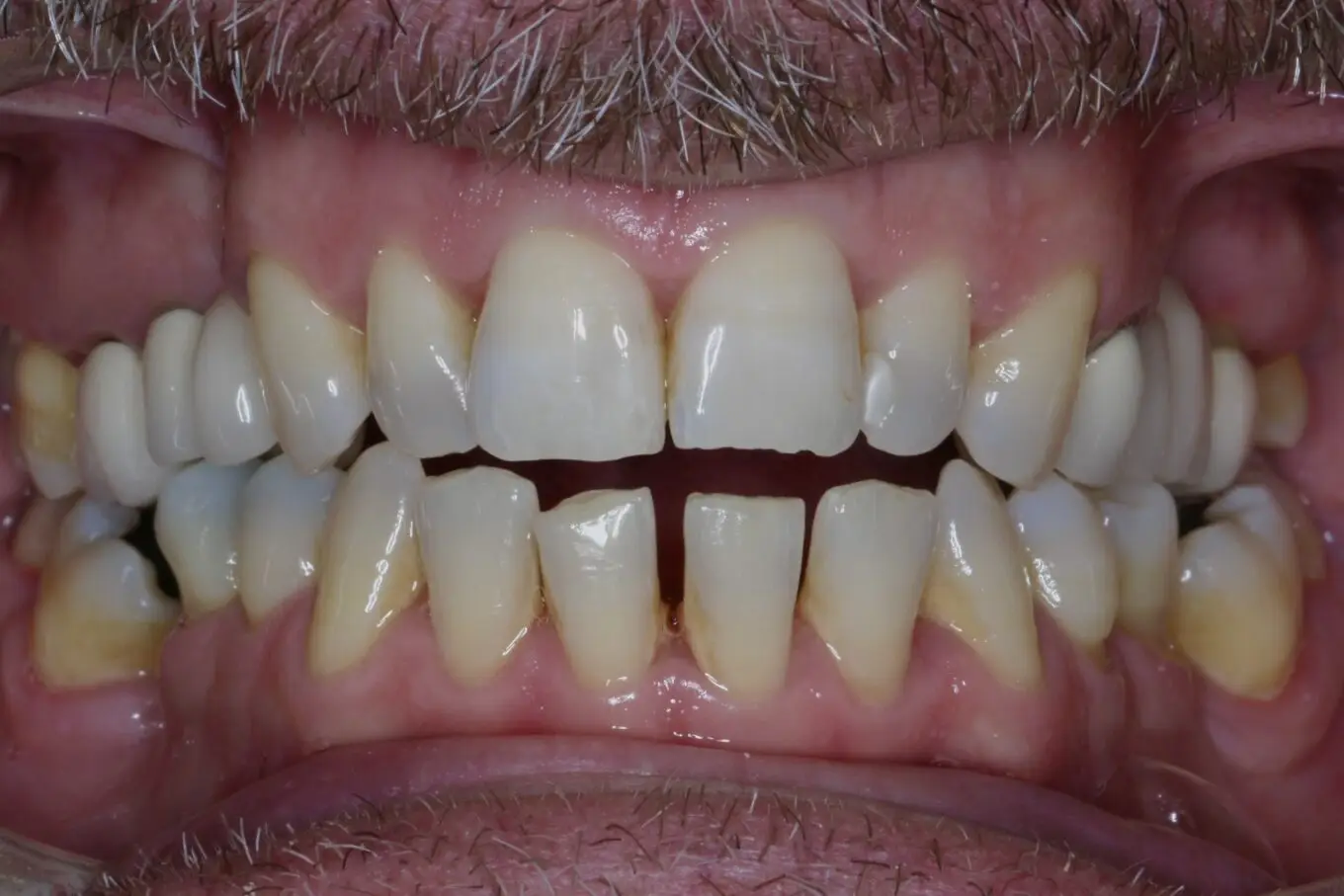 Teeth before | Invisalign Services | Schaumburg IL