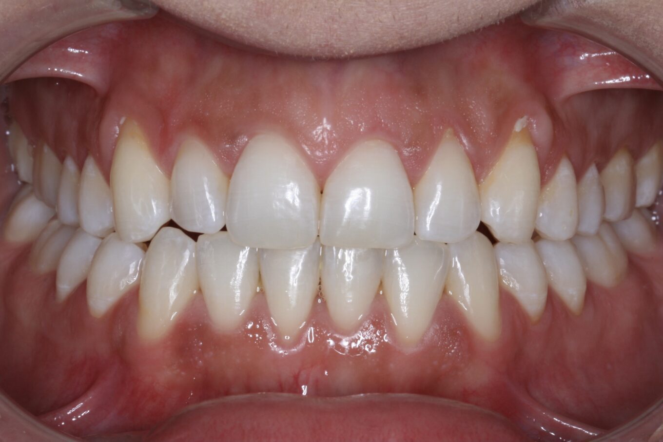 Teeth before| Invisalign Services | Schaumburg IL