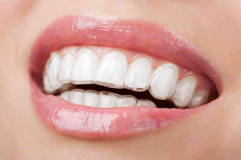Easiest Way To Have Invisalign