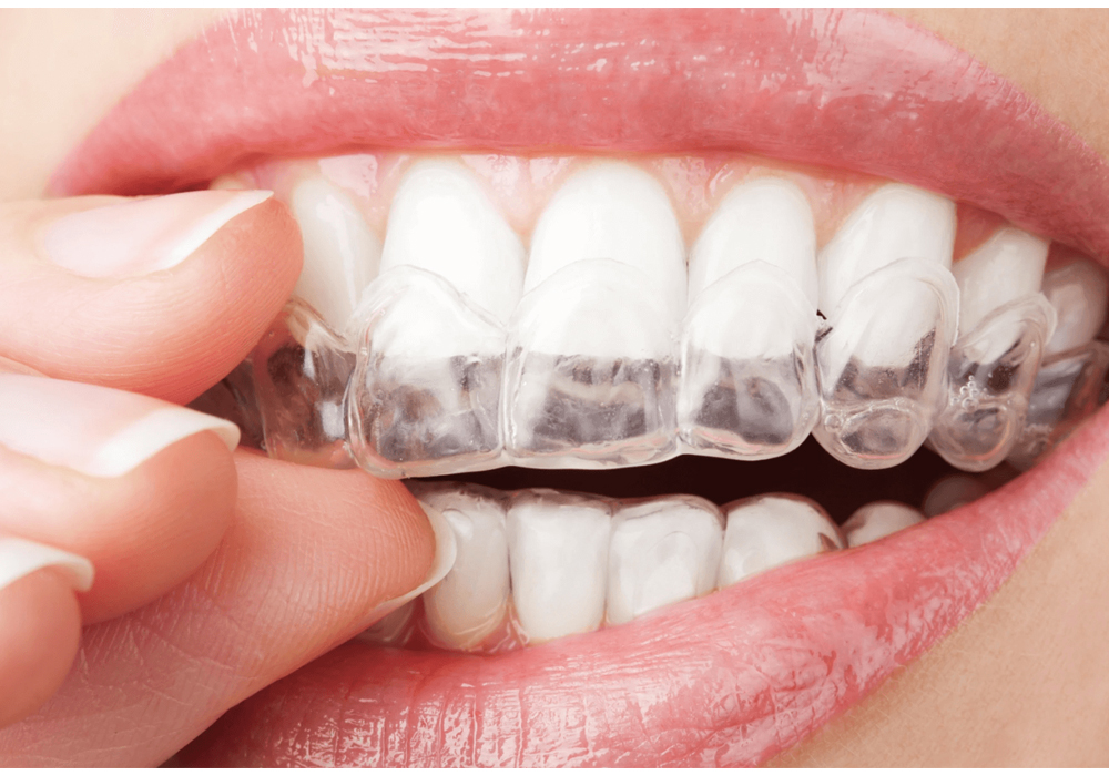 Invisalign Treatment And Clear Aligners Doctor | Schaumburg IL