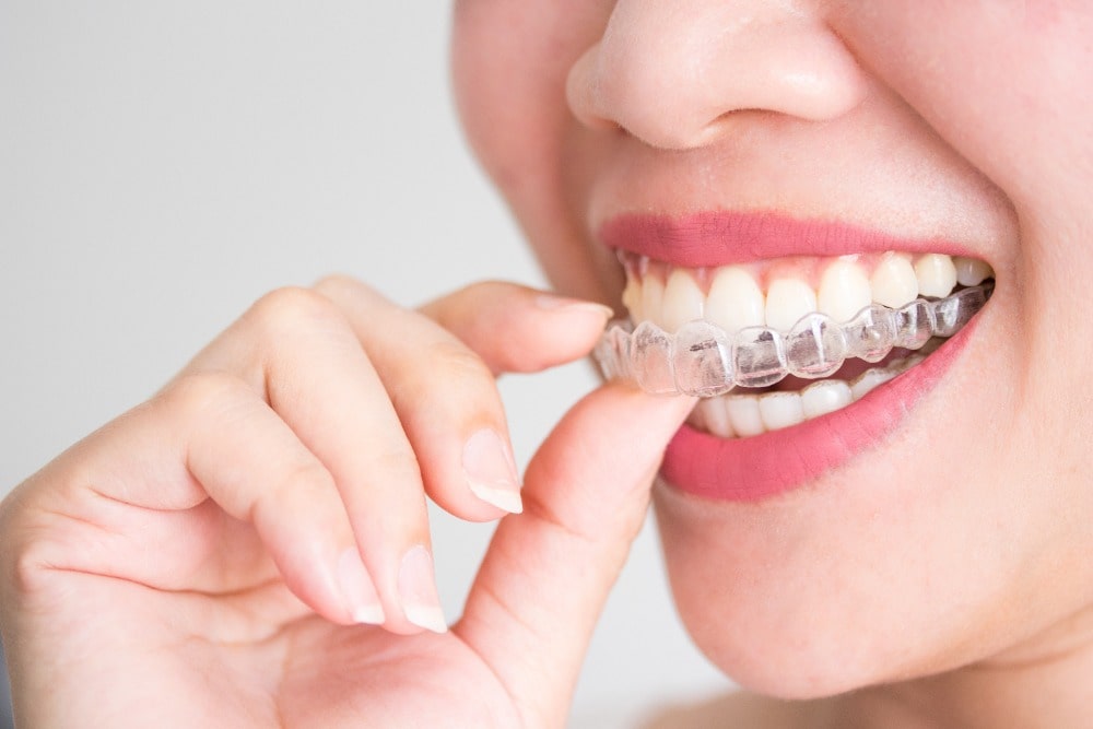 Invisalign Doctor Offer Services