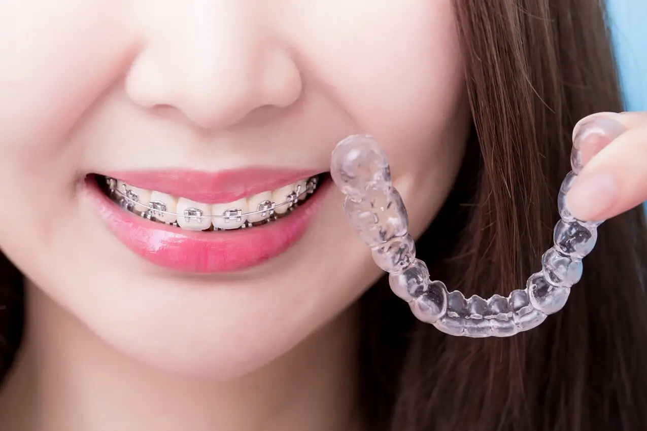 Invisalign Vs. Braces (The Pros and Cons)