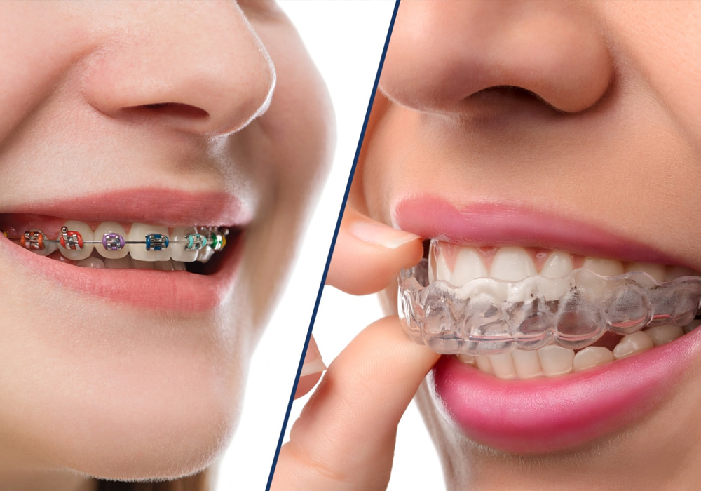 Pros And Cons Of Invisalign