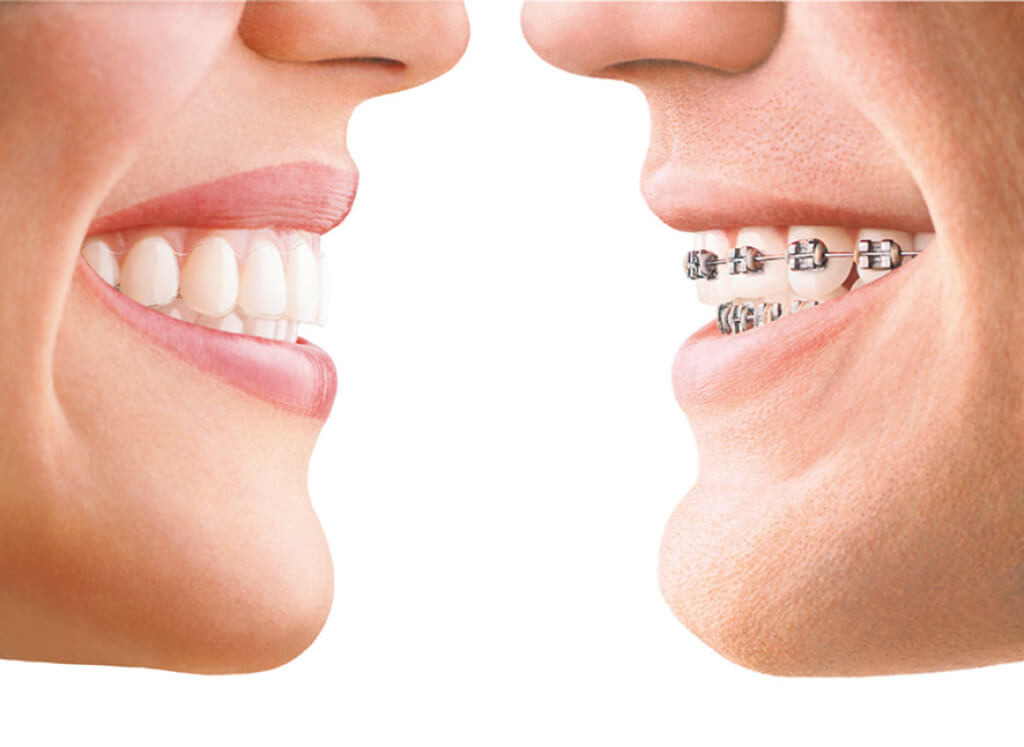 Invisalign And Braces: Which One Is Better?