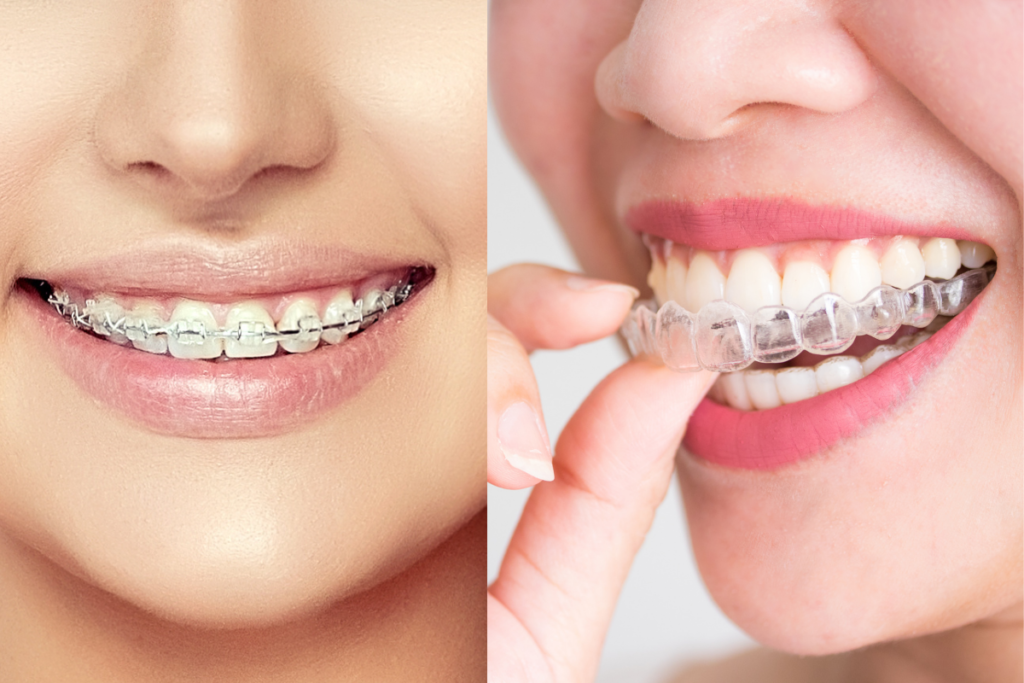 Difference Between Invisalign Vs. Braces