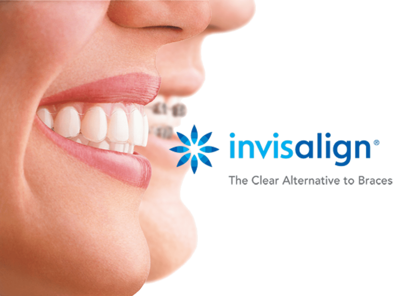 Invisalign Dentist In Schaumburg IL Will Change Your Smile Forever