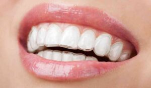 Everything You Need To Know About Invisalign®