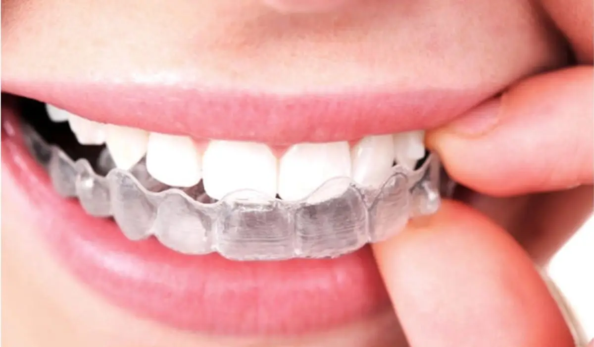 Do You Have To Wear Your Invisalign Retainer Forever?