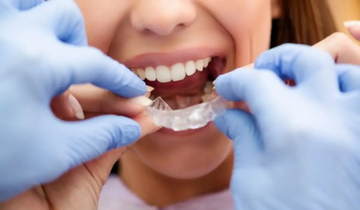 Benefits Of Clear Aligners