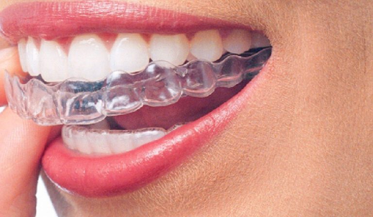 lady pushing a plastic clear aligner in mouth - Invisalign