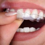 7 Things You Should Know Before Getting Invisalign